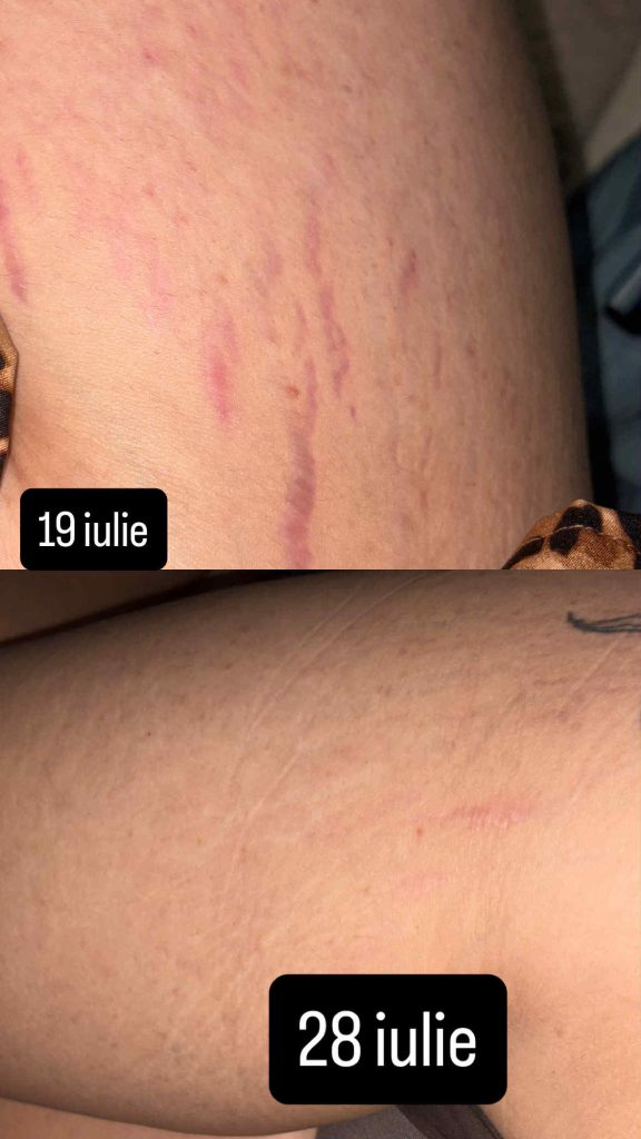 Mama DermaLift – Cremă Naturală Anti-Vergeturi Post-Sarcină (1)